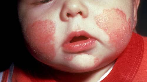 Терапия детского себорейного дерматита