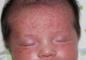 Аллергия у детей крапивница