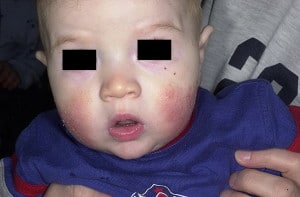 Атопический дерматит - младенческая стадия