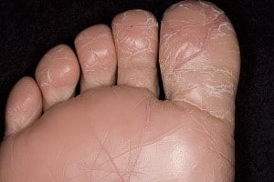 Атопический дерматит - поражение кожи стоп