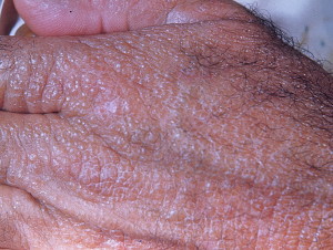 Гиалома (коллоидная дистрофия кожи)
