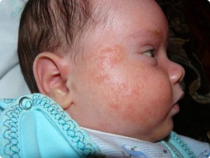 Атопический дерматит у новорожденных
